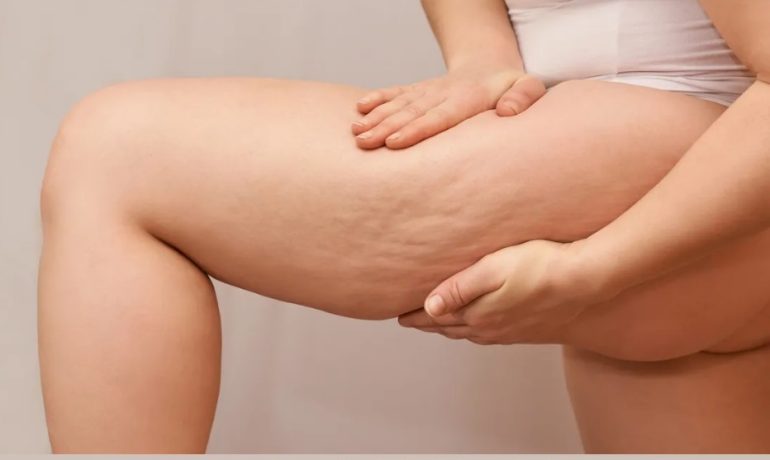 Qué es la celulitis y cómo mejorarla