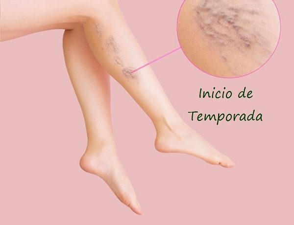 Varices y su tratamiento